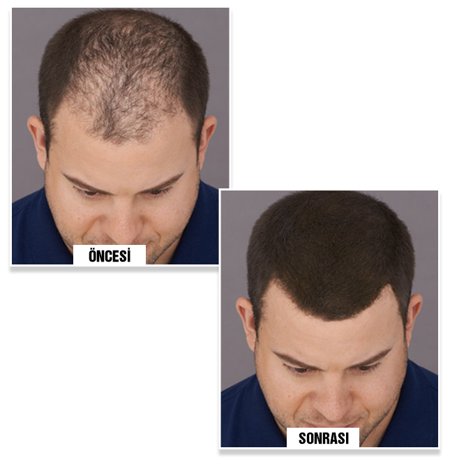  before and after using Bunee