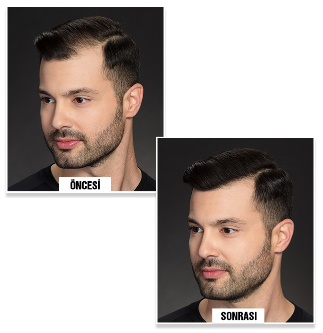  before and after using Bunee