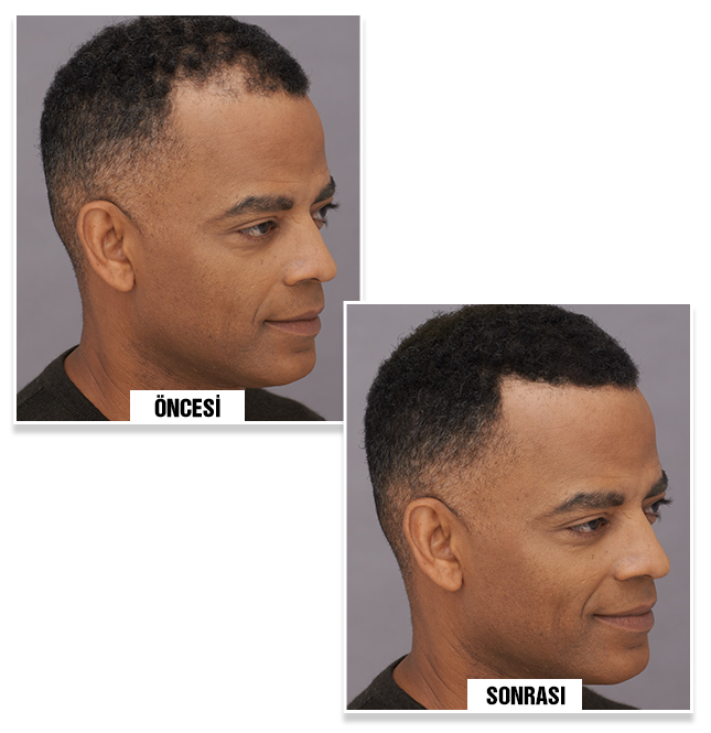 Alex G. before and after using Bunee